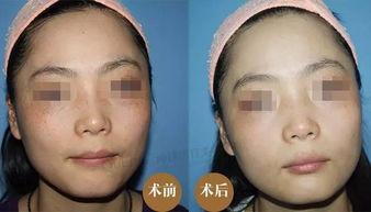 美容师祛斑爆料视频,真实案例分享  第3张
